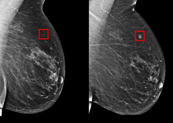 Trí tuệ nhân tạo phát hiện ung thư vú 5 năm trước khi nó phát triển. Nguồn: Science